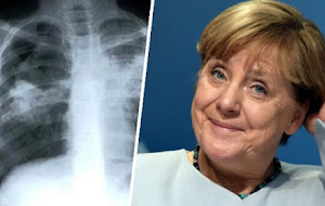 Merkelnek és vendégeinek köszönheti Európa a TBC új, halálos, ellenállóbb formáját