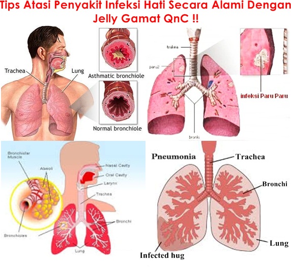 Pengobatan Alternatif Terbaik Infeksi Paru Paru