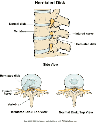 Herniated Belly Button. Herniated Belly Button