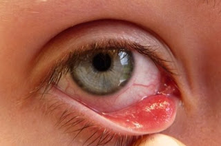 11 Home remedies for conjunctivitis