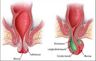 Obat Penyakit Wasir Dalam Alami, obat penyakit ambeyen ala hembing, obat ambeyen yang bagus apa ya, nama obat wasir, dragonrear obat buat penyakit ambeien, obat wasir di luwuk, obat buat penyakit wasir tradisional yg mujarab, obat ambeien atau wasir untuk wanita menyusui, obat wasir atau ambeien utk wanita hamil