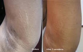 stretch marks. treating stretch marks