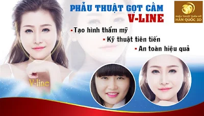 Phẫu thuật gọt cằm v line theo tiêu chuẩn Hàn