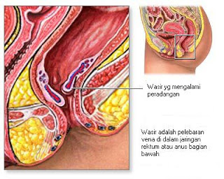 Obat Tradisional Manjur Untuk Ambeien Parah