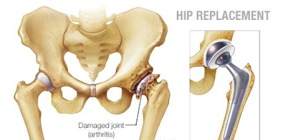 Hip replacement surgery