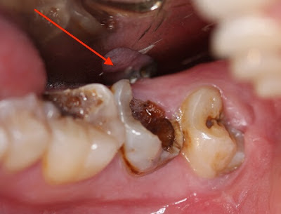 Nguyên nhân gây sâu răng hàm dưới không phải ai cũng biết 1