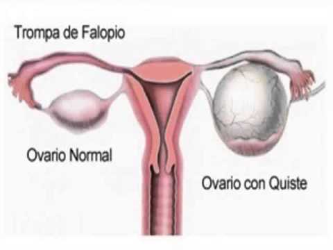 como me puedo cuidar para no quedar embarazada naturalmente