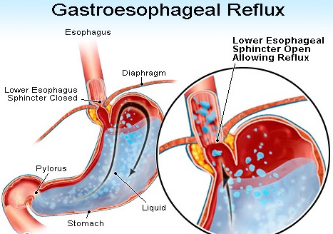 Acid Reflux-Gastro Esophageal Reflux Disease (GERD) | Simple Blog