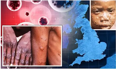 What is Monkeypox Outbreak??