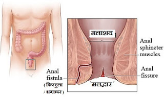 भगंदर और मलद्वार का चिरेदार घाव व उपचार विधि