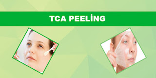 TCA Peeling