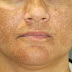 Obat Penghilang Melasma Yang Murah Dan Bagus Tanpa Efek Samping