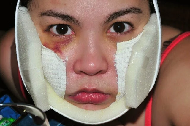Raymart Santiago reveals 'truth' behind Claudine Barretto's bruises