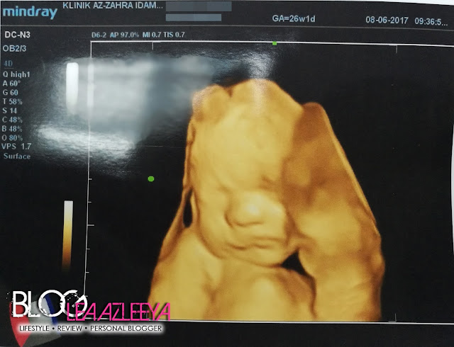 scan jantina anak, scan 2D, scan 3D, scan 4D