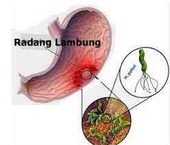 radang lambung