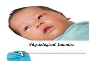 Physiological Jaundice