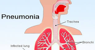 Gejala Dan Penyebab Pneumonia