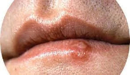 Herpes Labialis icd 10