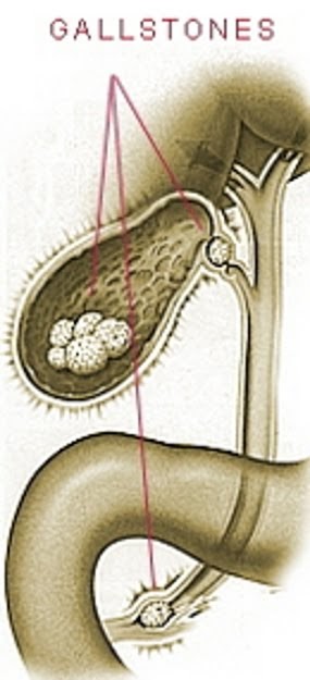 How do I treat Gall Stones in the medical world  Contoh 