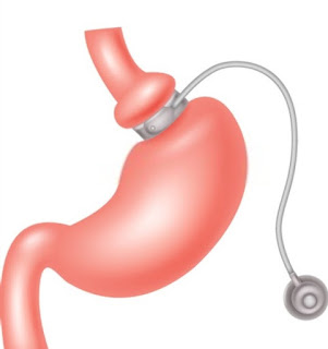 Gastric Banding