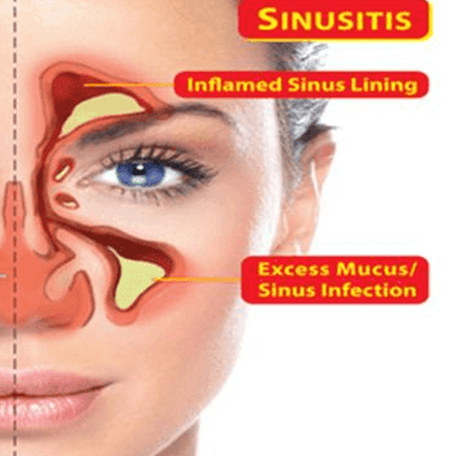 Pengobatan Sinusitis Dengan Varash