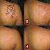 Laser Tattoo Removal in NYC Addresses