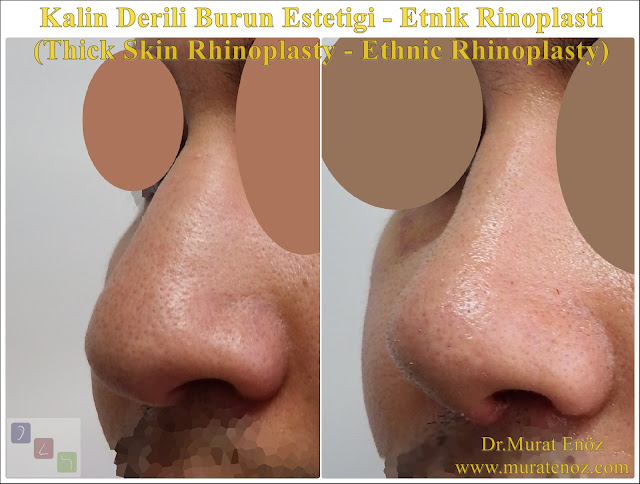 Ethnic rhinoplasty in nen  Istanbul - Ethnic nose job in Istanbul - Ethnic nose surgery in men Istanbul - Nose job in Turkey - Ethnic rhinoplasty in men Turkey - Ethnic rhinoplasty in Turkey - - Ethnic expert nose job surgeon - Ethnic rhinoplasty surgeon in Istanbul - Black nose job - Rhinoplasty for ethnic nose in men - Thick skin rhinoplasty - Thick skin rhinoplasty in men istanbul