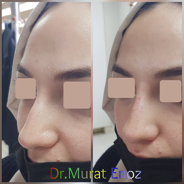 Non-surgical rhinoplasty with filler istanbul