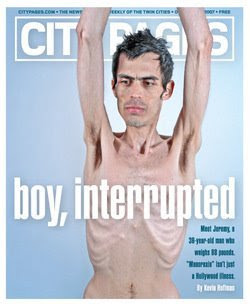 Jeremy Gillitzer, anorexic, bulimic, anorexia, bulimia