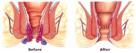 Harga Obat Wasir Dan Ambeien