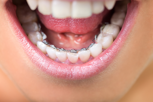 lingual braces treatment dubai
