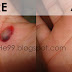 Remove Blood Blisters From Your Body [Home Remedies]