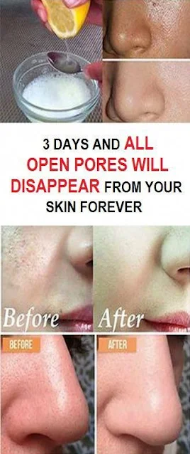 3 Days And All Open Pores Will Disappear From Your Skin Permanently