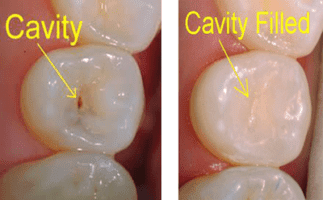 Teeth pain relief in hindi