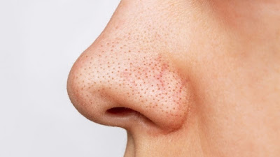 Cara Menghilangkan Komedo di Hidung Dengan 7 Cara