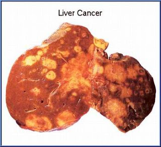 มะเร็งตับ [Hepatocellular carcinoma]