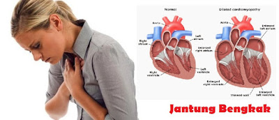 Penyebab Jantung Bengkak & Obat Jantung Bengkak TERBUKTI MUJARAB Menyembuhkan Jantung Bengkak