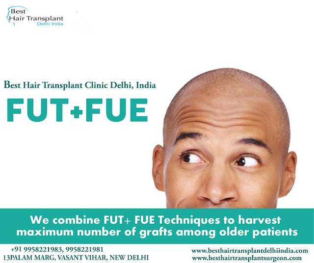 FUE hair surgery in delhi, hair loss treatment in delhi, hair transplant surgery in delhi, best hair restoration surgery in india, fue hair transplant delhi,  #scalpreduction, #prptreatment, #besthairtransplant, #hairsurgeon, #FUE, #FUT, #moustaches,  #beards , #eyebrows,  #eyelash, #mesotherapy, #hairreplacmentcost