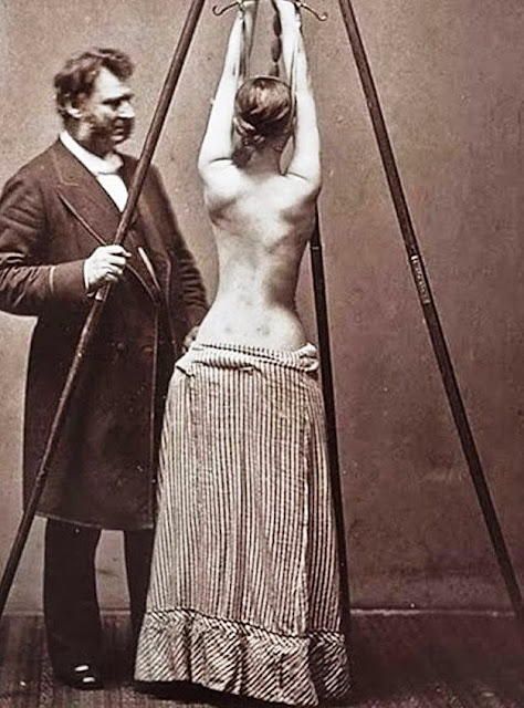 how to treat scoliosis in the past