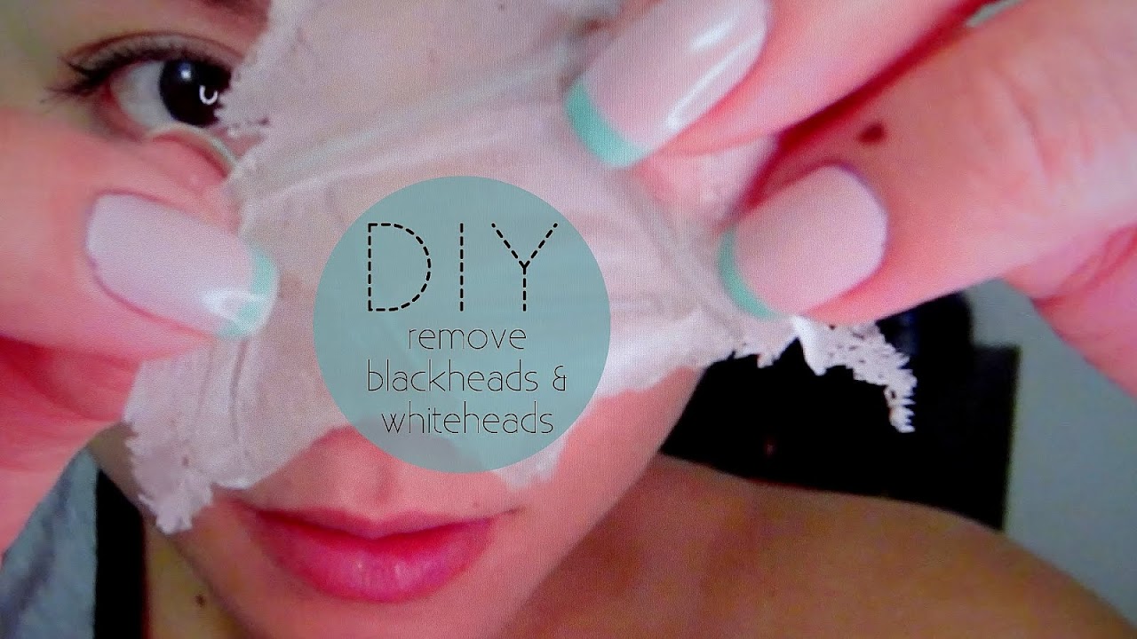 How To Remove Blackheads And Whiteheads From Face