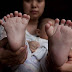 شاهد.. ولادة نادرة لطفل صيني بـ31 أصبعا 