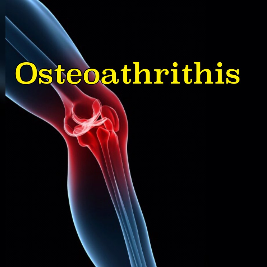 Osteoathrithis