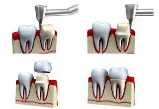 Bọc răng sứ cho răng hàm bị sâu có được hay không ?