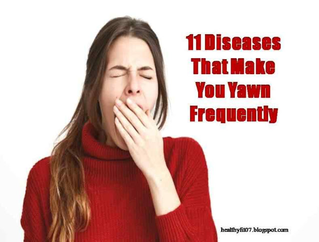 Diseases That Make You Yawn Frequently