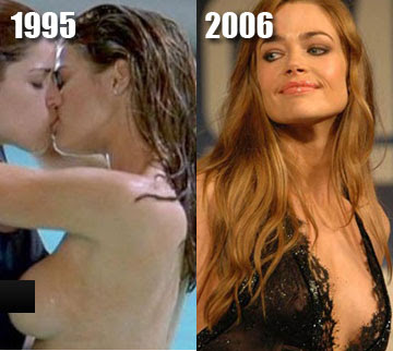 Denise Richards' Breast Augmentation2