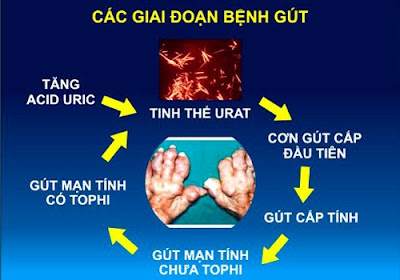 Cách chữa bệnh gout theo từng giai đoạn bệnh