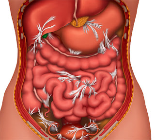 Abdominal-Adhesions