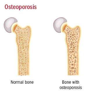 Osteoporosis