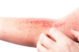 Dermatitis Atopik