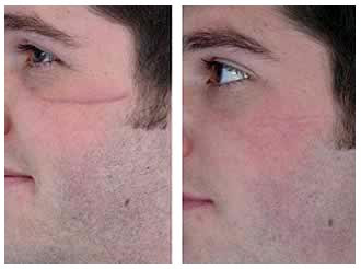 Scar Removal Before And After